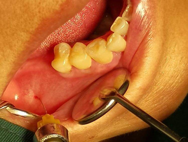 种植牙钛合金是金属吗,种植牙种植体对骨头好吗