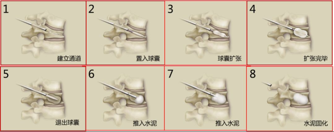 老年人腰部压缩性骨折怎么治疗,腰部压缩骨折多久才能恢复
