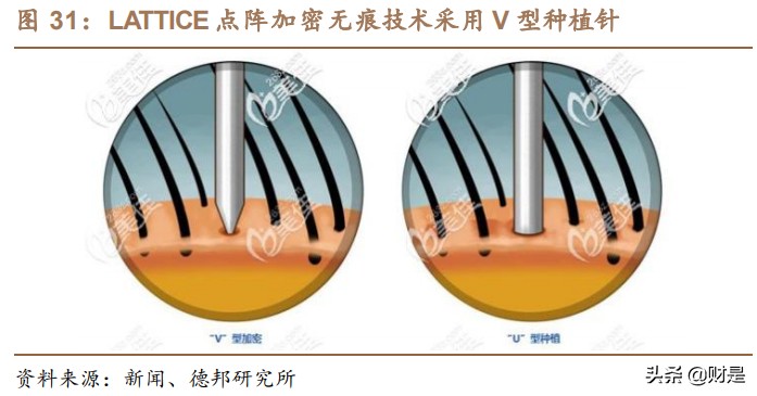 植发市场行业分析,植发养发行业的未来趋势