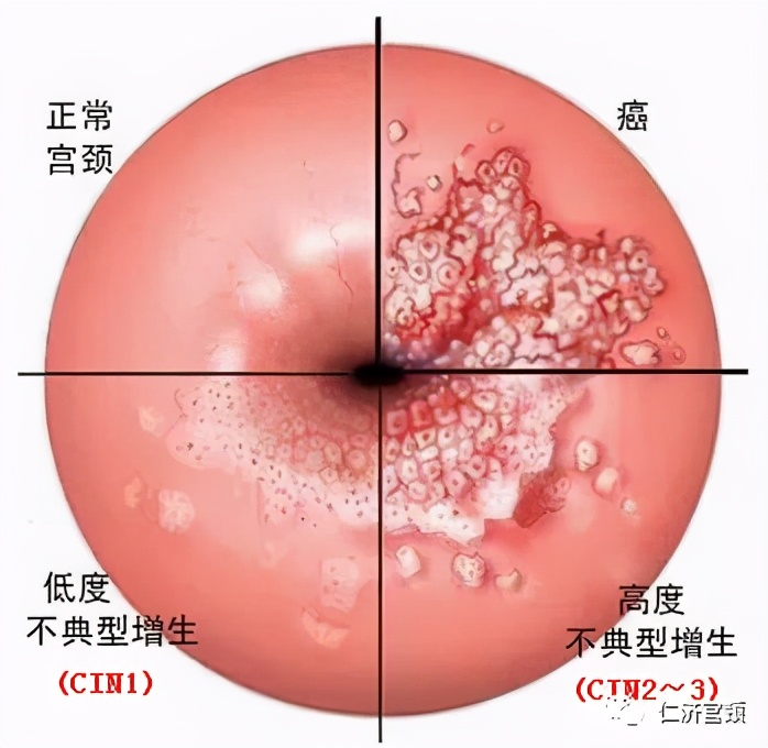 leep手术后遗症,锥切leep手术