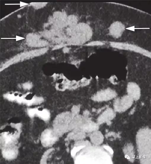 腹壁病变诊断思路,腹部影像诊断读片入门视频