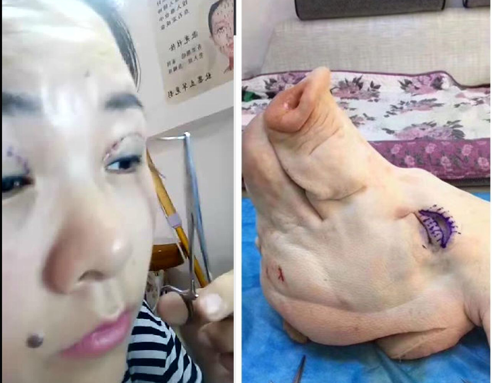 整形医院做双眼皮怎么不被坑,整形医院做双眼皮失败如何投诉