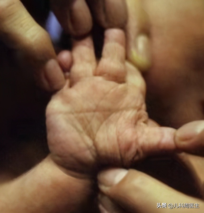 高龄唐筛21三体临界风险有没有事,唐筛21三体综合征会不会误诊