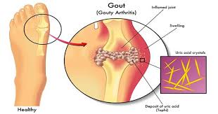 尿酸高不用药能自然恢复吗,尿酸高最快的恢复方法就是多喝水