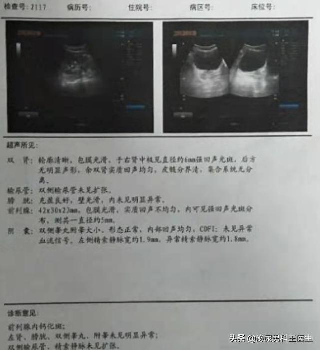 前列腺钙化是结石的表现吗,前列腺钙化有哪些症状表现