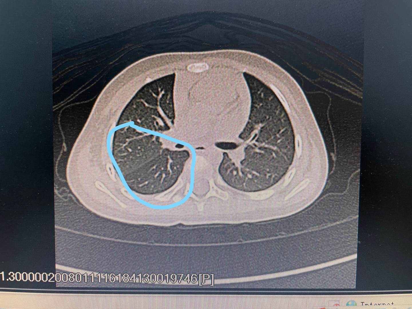 宝宝气管呛到异物反复发烧咳嗽吗,婴幼儿支气管异物咳嗽表现