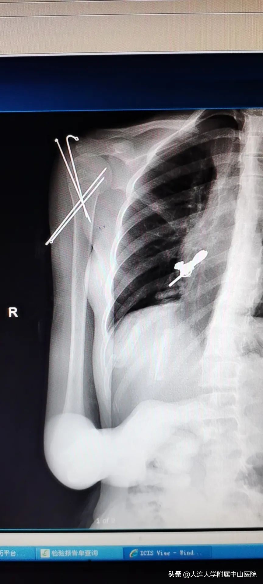 儿童骨折受伤视频,小孩骨折固定案例