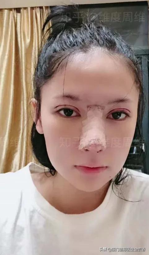 鼻子变挺的方法,想要鼻子变挺去哪里好