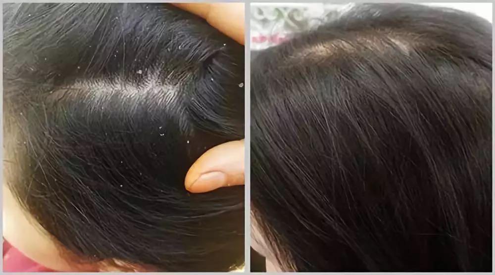 沙宣洗发水不去屑,沙宣洗发水掉发又油