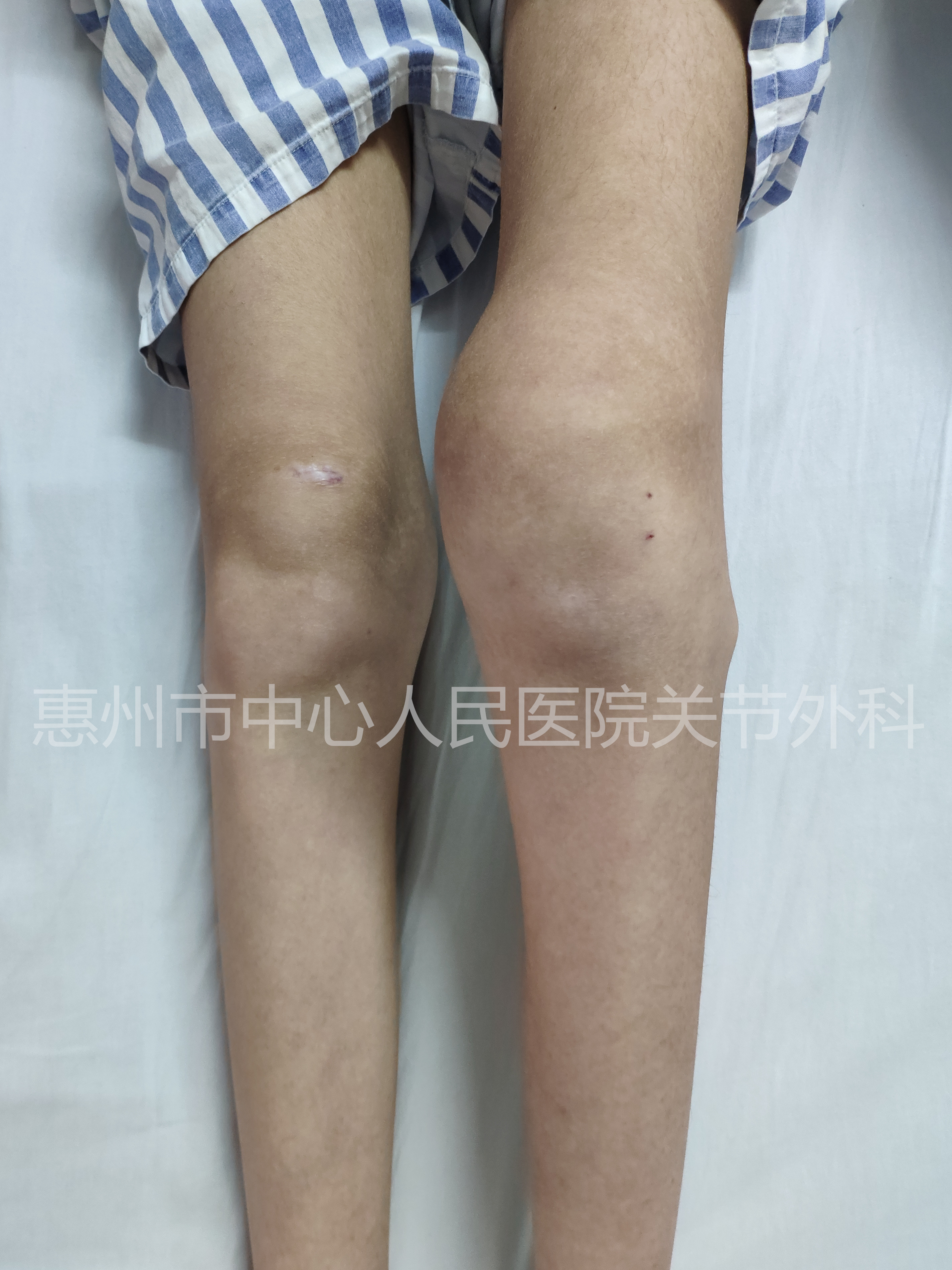 “关节炎”骨科科普逐个说之“化脓性关节炎”