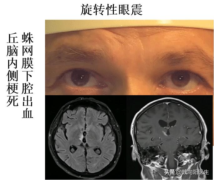 良性位置性眩晕鉴别,怎样判断眩晕是颈椎还是耳石症