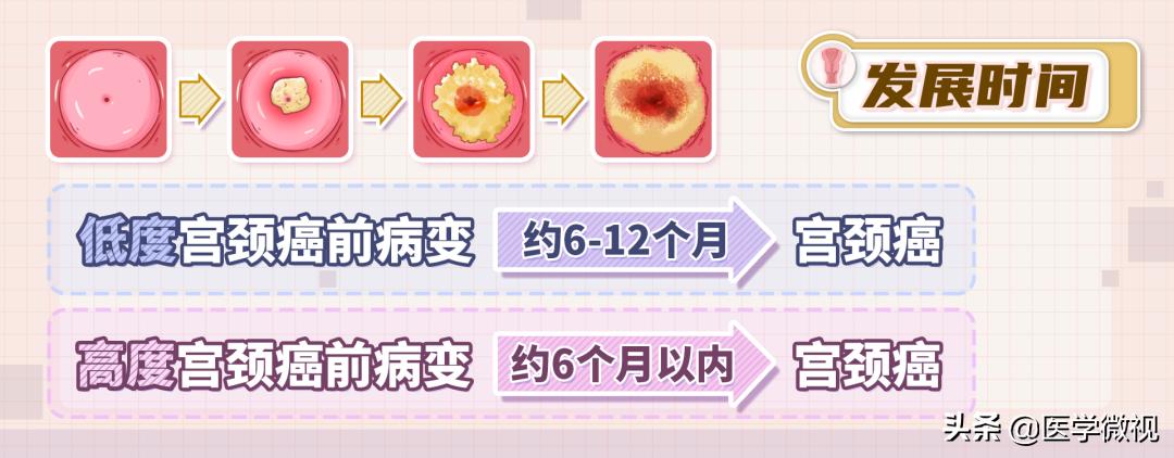 tct和hpv检查哪个确诊宫颈癌,宫颈癌tct检查是什么结果