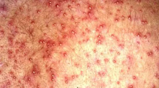 痱子和湿疹如何正确区分,怎么区分痱子和湿疹