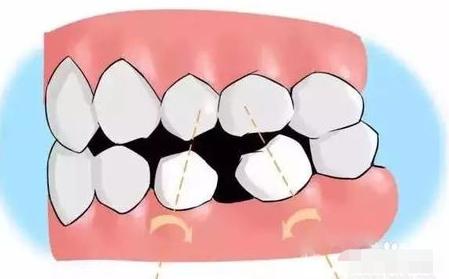 小孩乳牙不小心咽下去了怎么办,儿童乳牙摔松动了能自己恢复吗