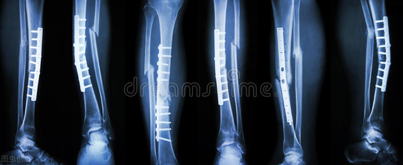 钢板断二次骨折出院如何维权,骨折钢板断裂怎么维权