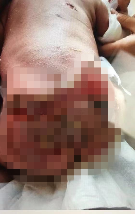 出生23天婴儿洗澡病危后续,男婴被烫伤后续