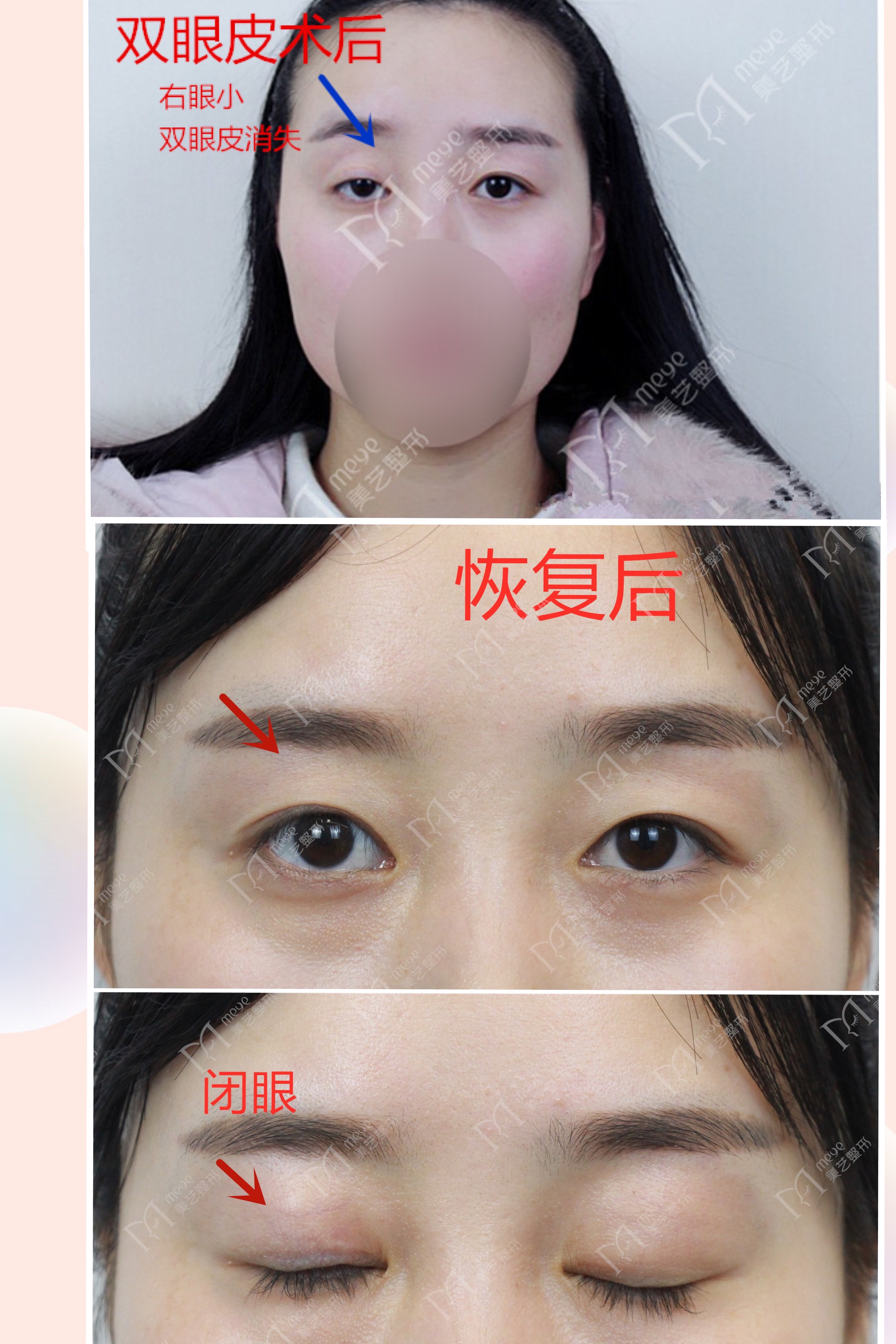 女子双眼皮术后大小眼,大小眼做了双眼皮感觉眼角不对称