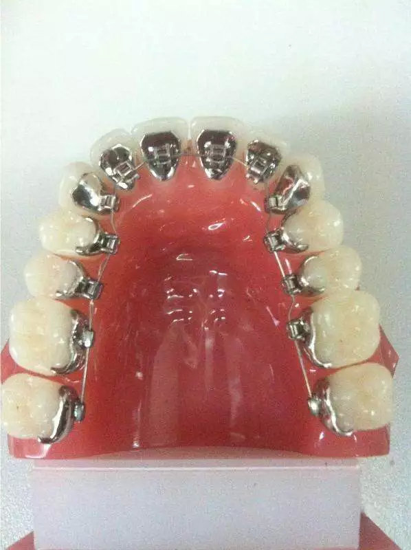 矫牙经历的几个阶段,矫牙过程难受吗