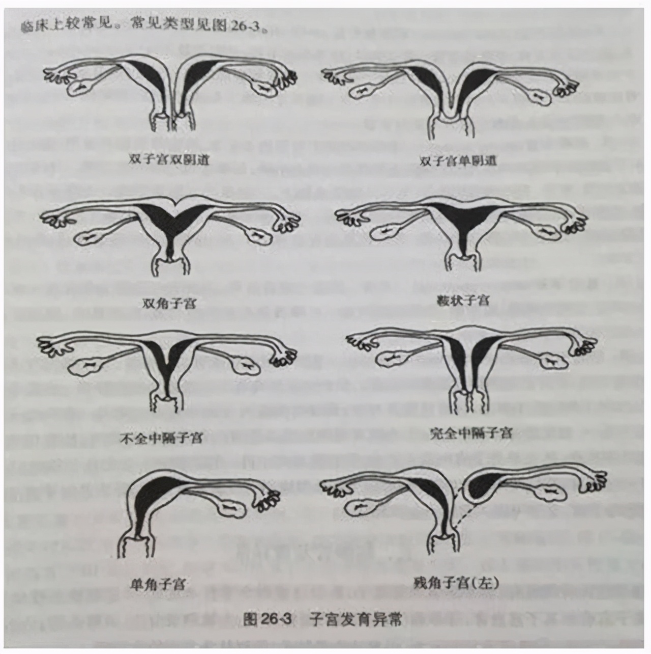 女子被查出有双子宫,24岁女子体检发现有两个子宫