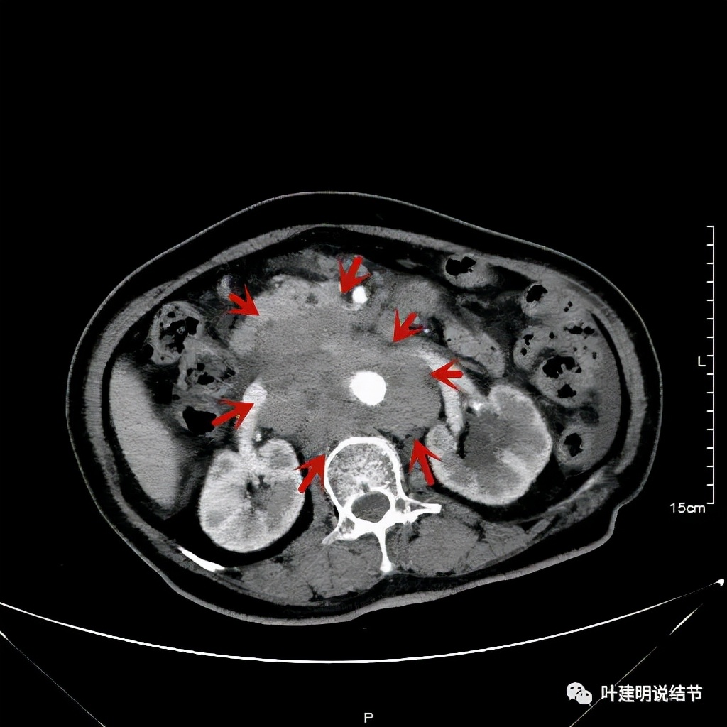 特瑞普利单抗食管癌成功案例,特瑞普利单抗治疗食管癌效果好吗