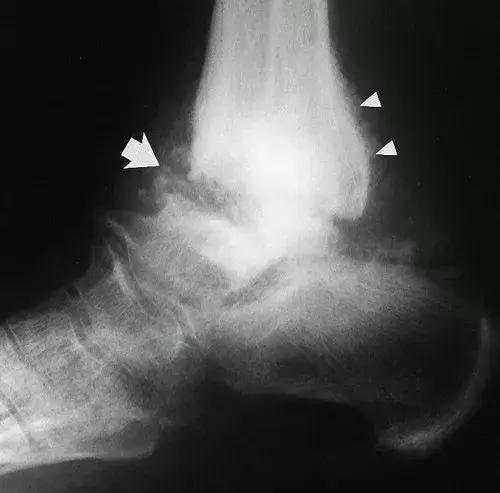 神经性骨关节病,神经性关节炎症状图片