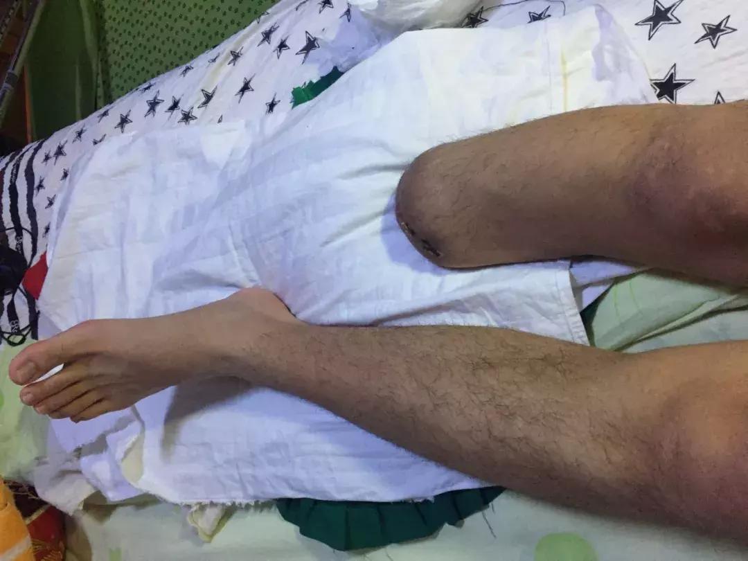 中国留学生被截肢,励志留学生