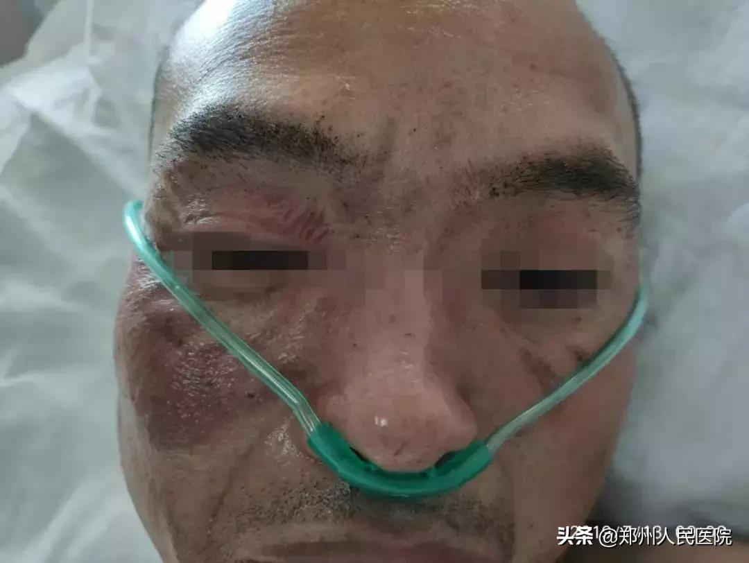 “砰”的一声，我把自己送进了ICU—“一位电击伤患者的自述”
