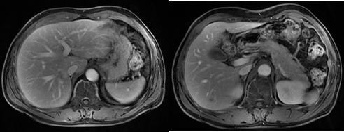 放疗局控百分百：鼻咽癌肝转移化疗联合免疫治疗失败后