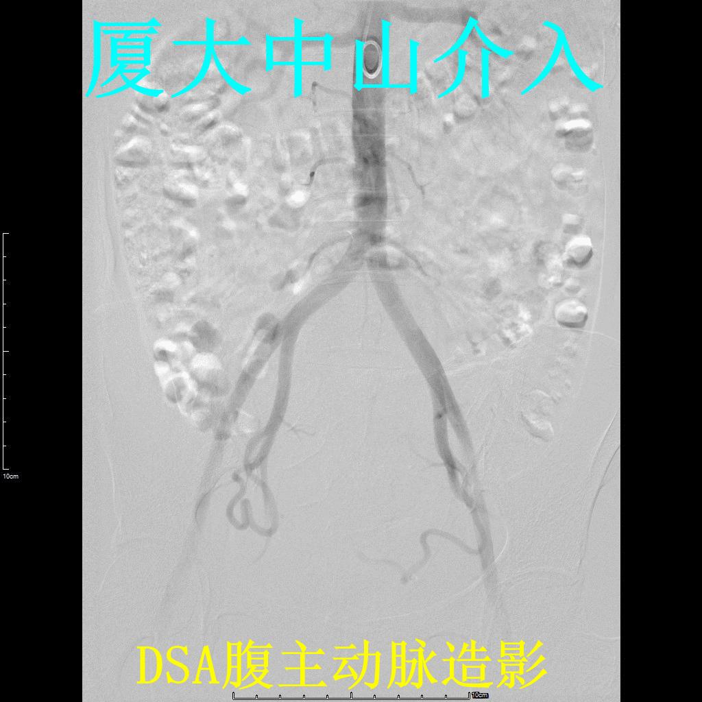 子宫肌瘤介入栓塞对子宫影响,子宫肌瘤介入栓塞的副作用