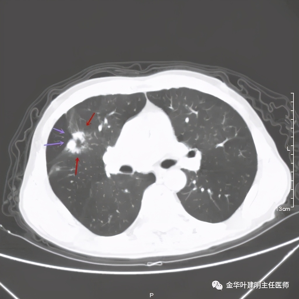 得了肺癌做肺部穿刺有影响吗,肺部穿刺可以确诊肺癌吗