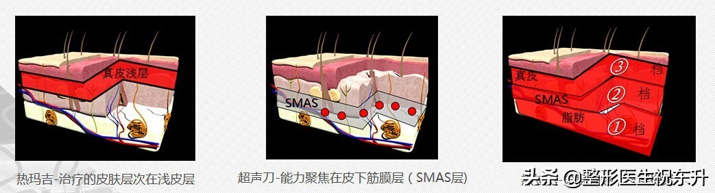 超声刀和热玛吉有必要都做吗,超声炮热玛吉热拉提哪个效果好