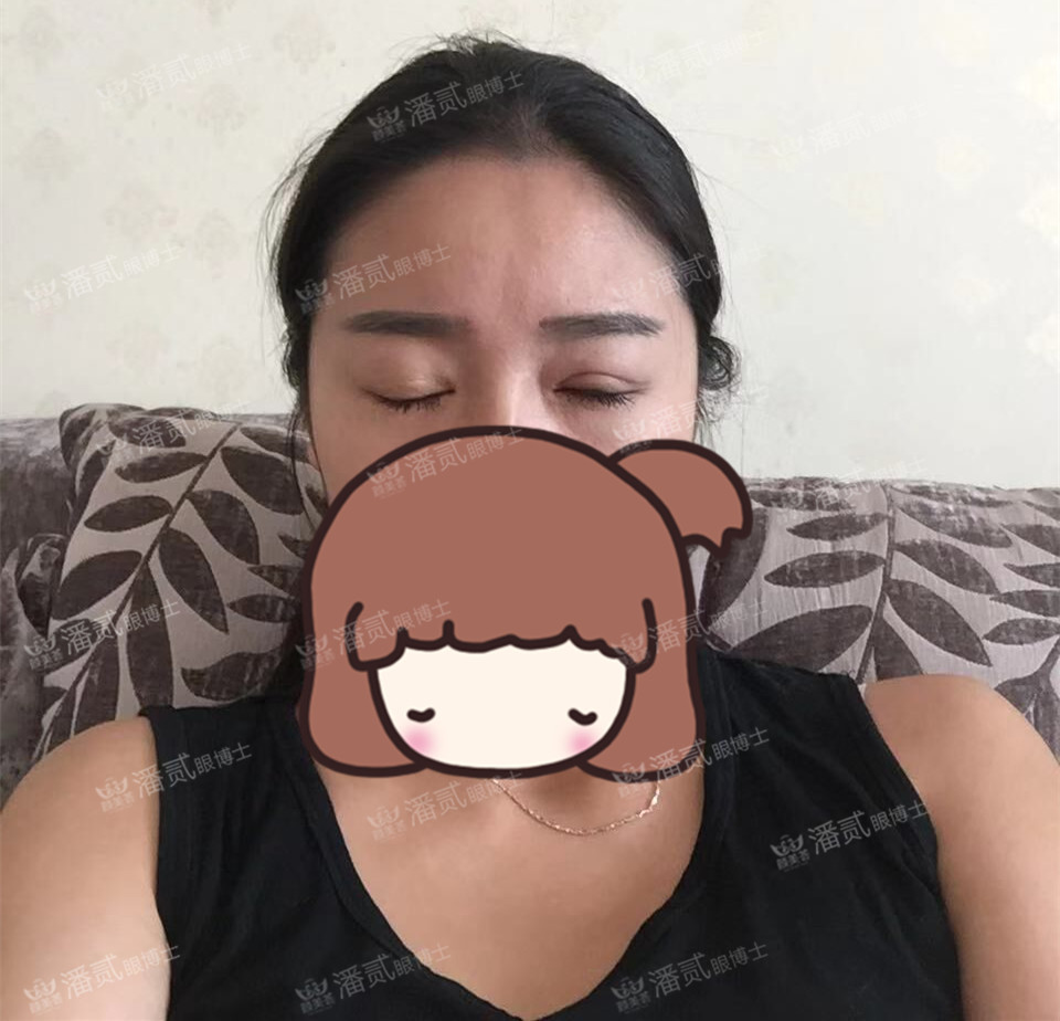 提肌矫正失败的表现眼皮睁不开,做完提肌眼睛前半段下垂