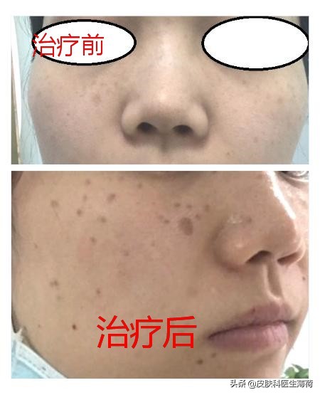 祛斑祛红色痘印激光,点阵激光祛斑仪器