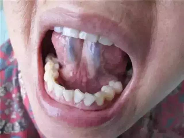 刺络放血疗法督脉,络脉刺血疗法教学视频