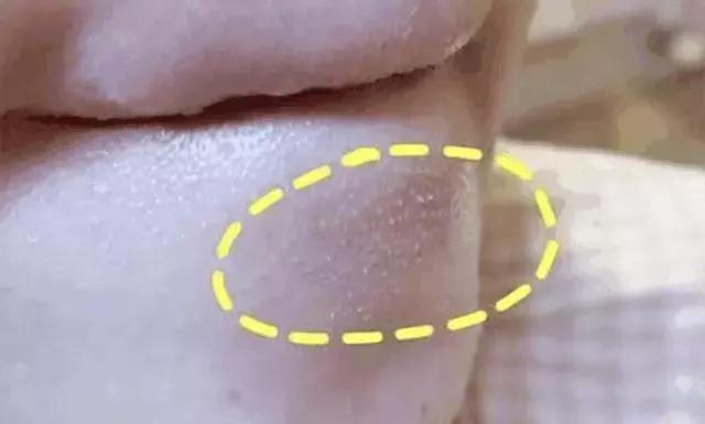 抿嘴时下巴密密麻麻小疙瘩,下巴长了好多凸起来的小疙瘩