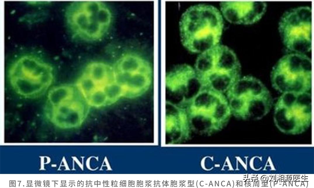 系统性血管炎怀孕能要吗,怀孕得了血管炎怎么办