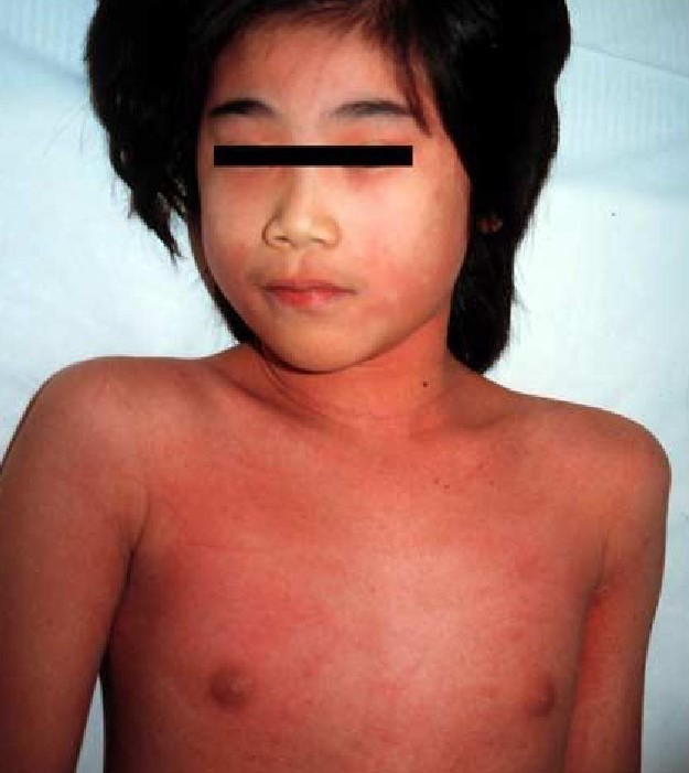 猩红热出完疹子还是发烧怎么回事,发热咽痛出荨麻疹