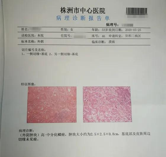 23岁女士得外阴癌,外阴瘙痒是外阴癌的前兆吗