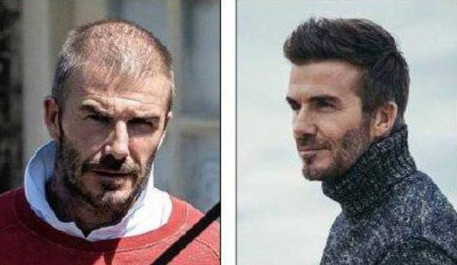 植发二年后又掉光了头发,小贝植发