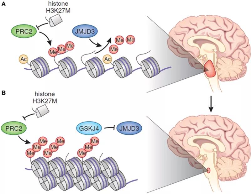 一级脑干胶质瘤,脑干胶质瘤指南