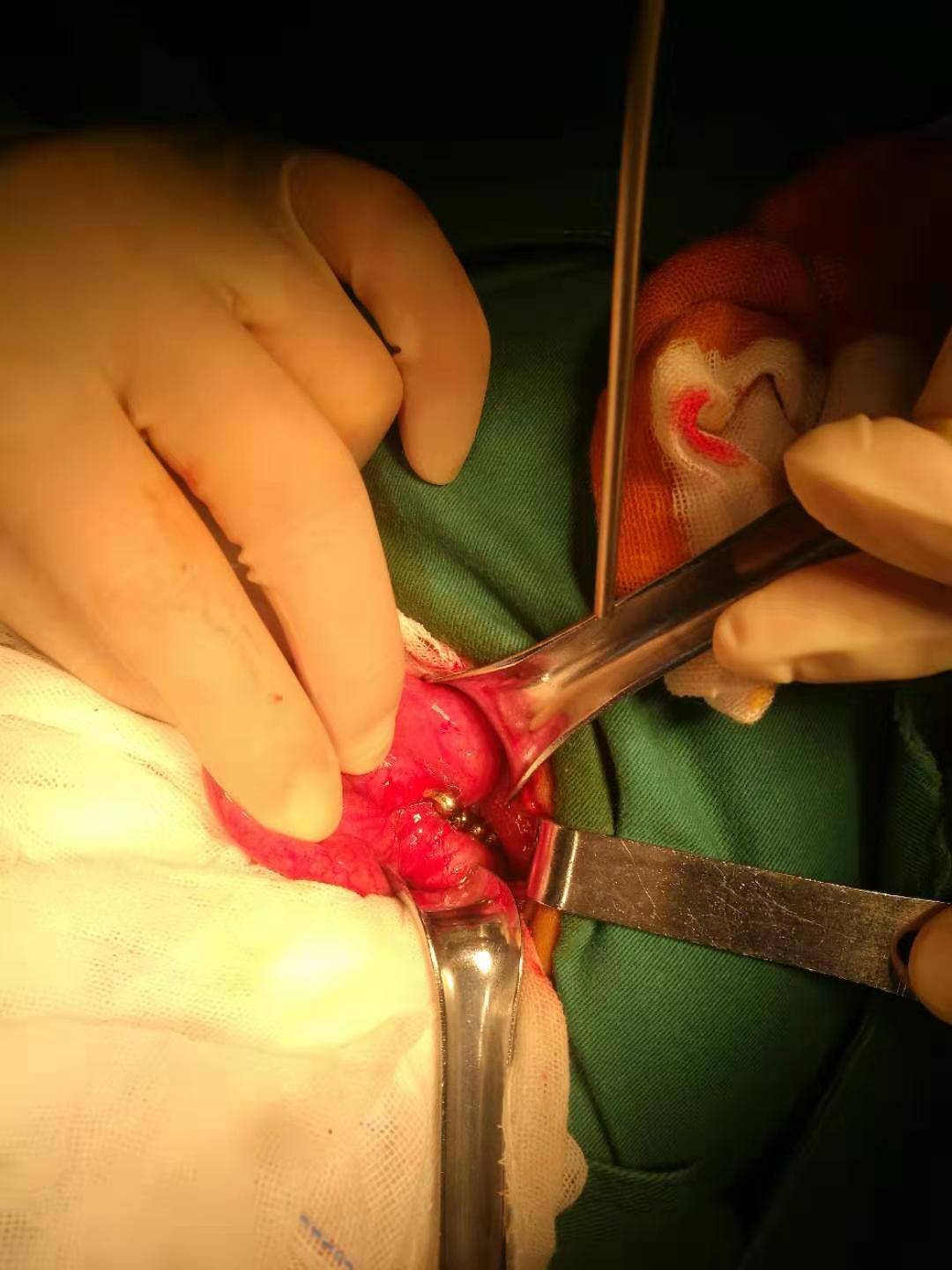 男童误吞11颗磁力珠后来怎么处理,男童误吞11颗磁力珠新闻