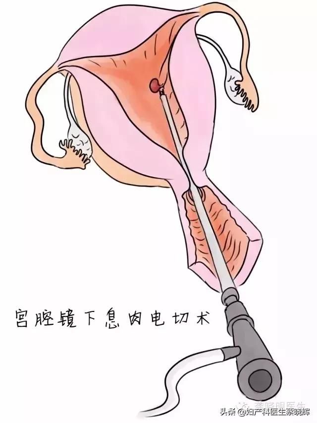 宫腔镜手术后亲身经历,宫腔镜手术提早做还是备孕前做