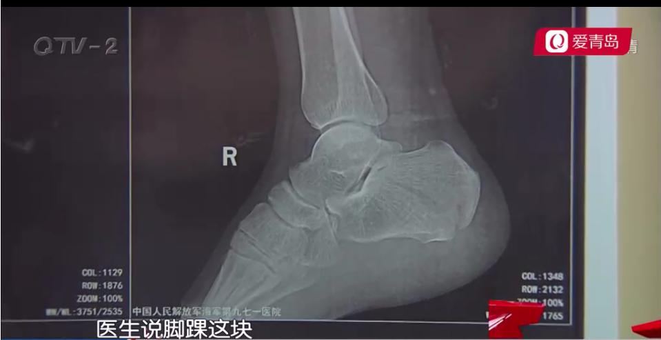 小饭店打工受伤误工费怎么算,酒店摔伤误工费标准