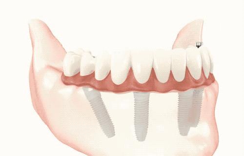 老年人缺牙怎样解决最好,中老年缺牙怎么办