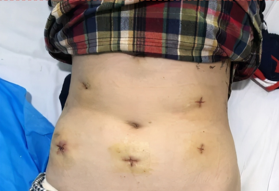 直肠癌的常用手术方式及其适应症,直肠癌手术的风险大吗