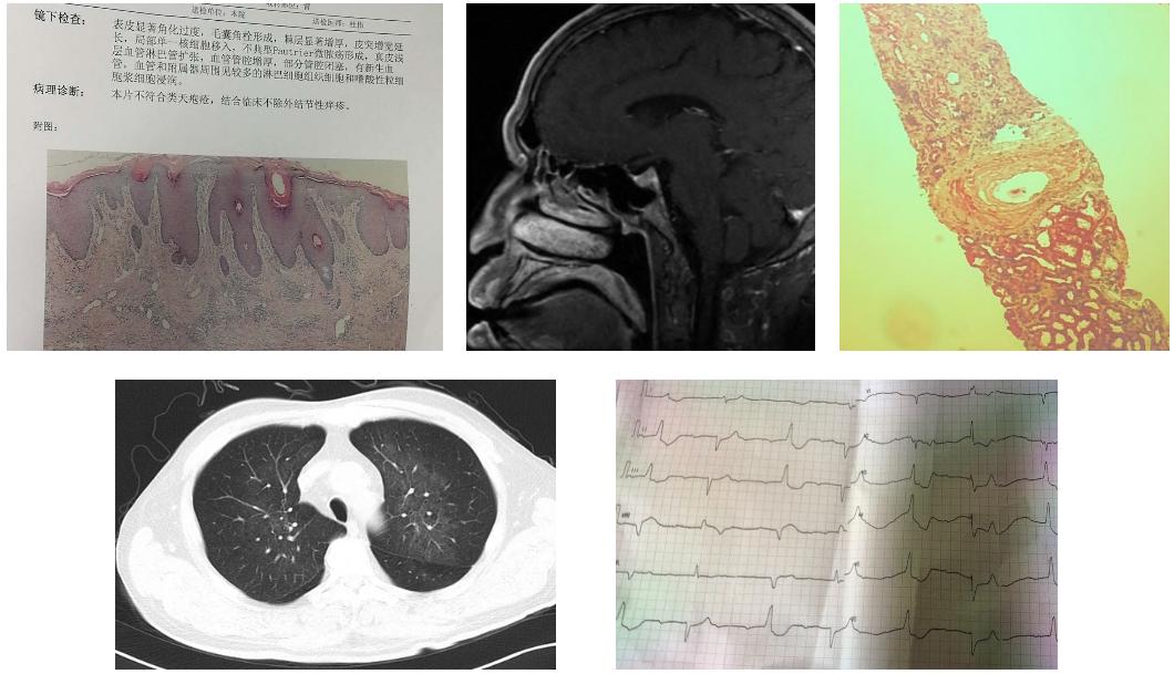 王孟昭看肺癌怎么样,王孟昭大细胞肺癌