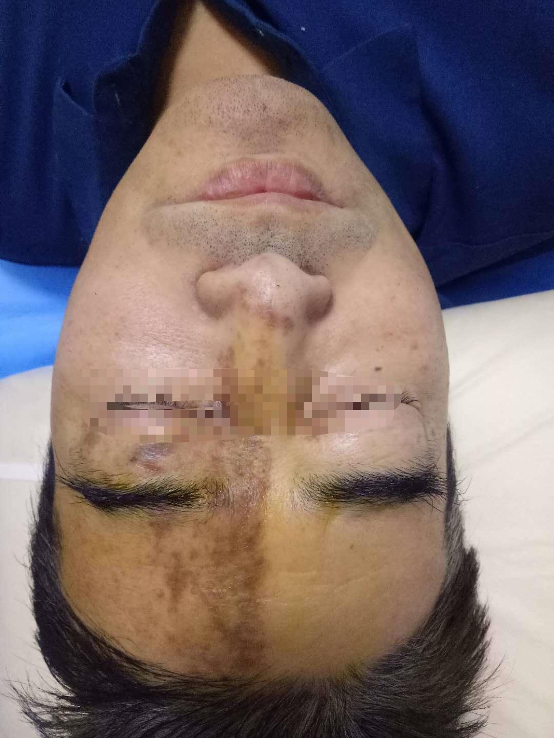 带状疱疹好治疗吗,带状疱疹合并糖尿病为什么难治