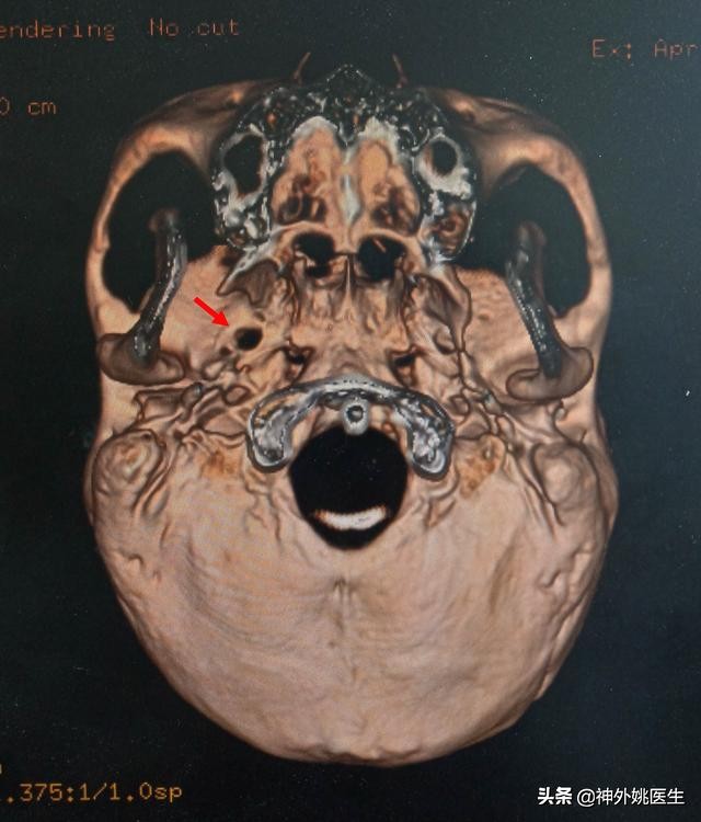 三叉神经痛微创治疗方法,超微创定向修复三叉神经