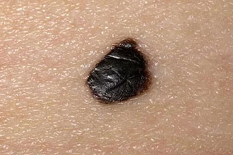 怎么去掉身上的黑痣,如何防止黑痣切除之后再复发