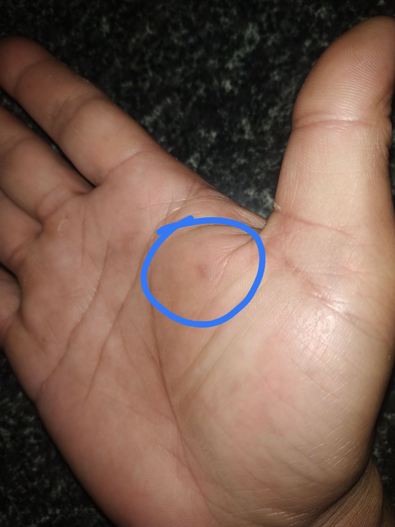 手受伤后，附近血管感觉有些堵塞，摸起来有个小包，这是怎么回事